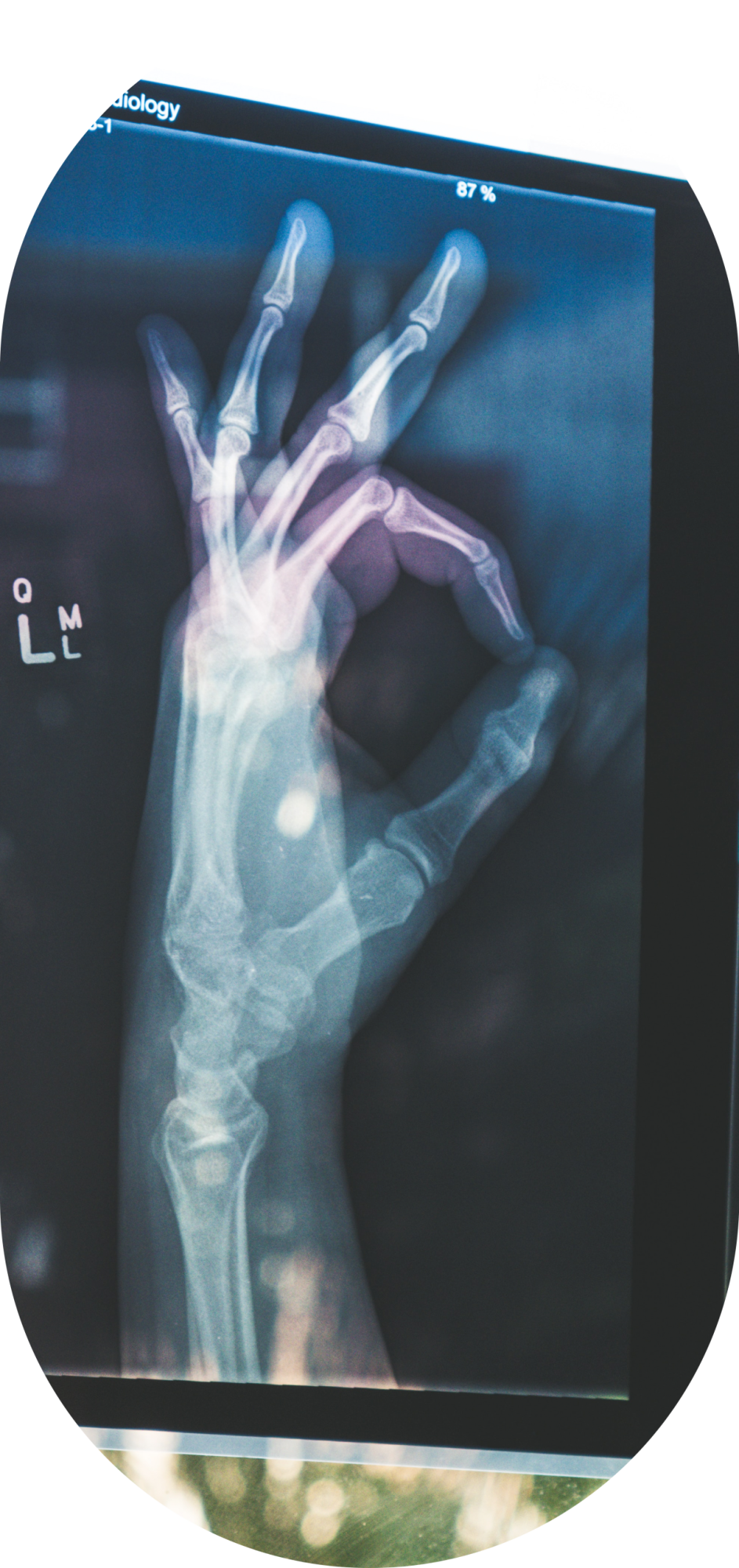 Una radiografía de una mano