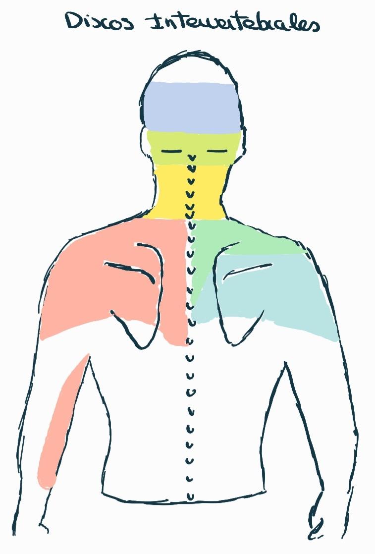 cervicalgia. Dolor de cuello